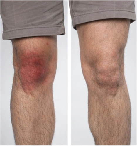 Swelling, Redness & Warmth — Possible Infected Knee Replacement