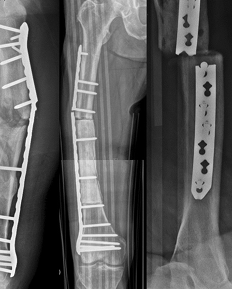 Broken Plate, Bent Nail or Failed Implant — Revision Fixation Required